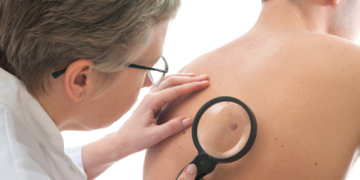 Vorsorge von Kopf bis Fuß: Hautkrebs-Screening im Kreis Herzogtum Lauenburg wird immer weniger genutzt