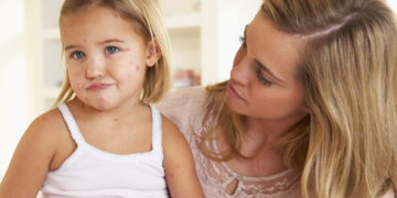 Mehr Windpocken-Fälle im Kreis Herzogtum Lauenburg
