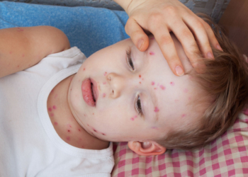 Windpocken-Fälle im Kreis Herzogtum Lauenburg angestiegen