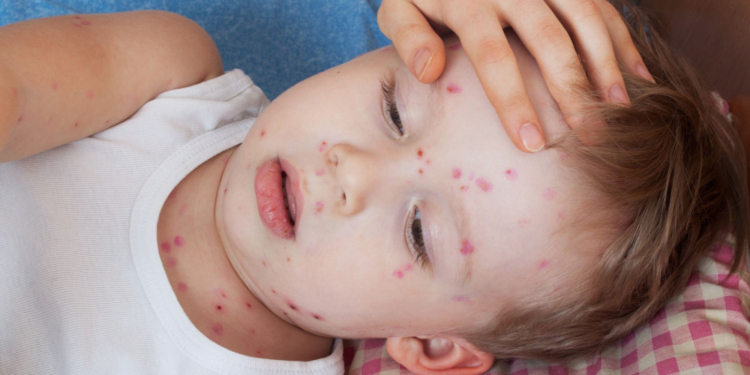 Windpocken-Fälle im Kreis Herzogtum Lauenburg angestiegen