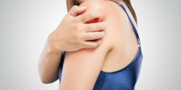 Krätze-Fälle im Kreis Herzogtum Lauenburg gesunken