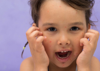 Deutlich weniger Windpocken-Fälle im Kreis Herzogtum Lauenburg