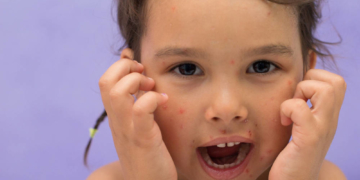 Deutlich weniger Windpocken-Fälle im Kreis Herzogtum Lauenburg