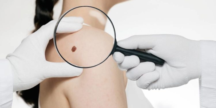 Hautkrebs-Screening wieder mehr genutzt