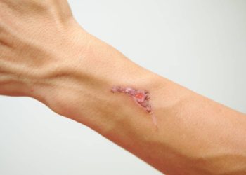 Blutvergiftung – ein Notfall, der oft nicht erkannt wird