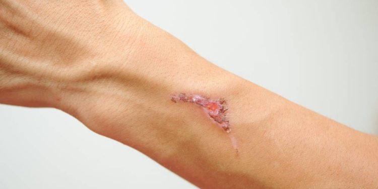 Blutvergiftung – ein Notfall, der oft nicht erkannt wird