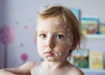 Windpocken-Fälle im Herzogtum Lauenburg wieder angestiegen