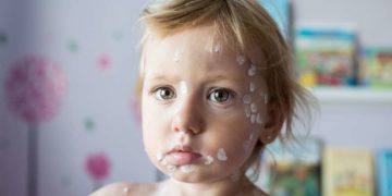Windpocken-Fälle im Herzogtum Lauenburg wieder angestiegen