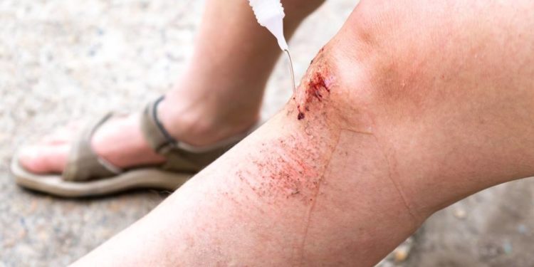 Blutvergiftung ist eine oft unterschätzte Gefahr