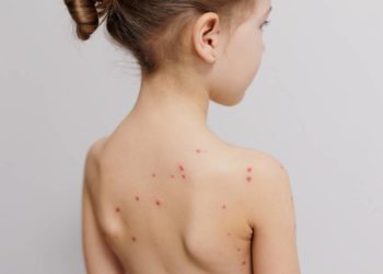 Windpocken-Fälle im Herzogtum Lauenburg angestiegen