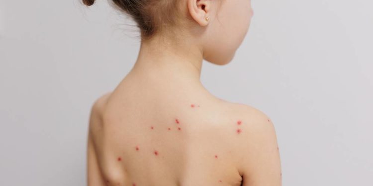 Windpocken-Fälle im Herzogtum Lauenburg angestiegen