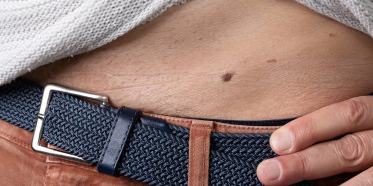 Hautkrebs-Screening bleibt auf niedrigem Niveau