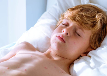 Vorsicht Ansteckungsgefahr: Windpocken-Fälle im Herzogtum