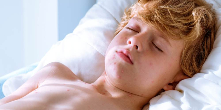 Vorsicht Ansteckungsgefahr: Windpocken-Fälle im Herzogtum