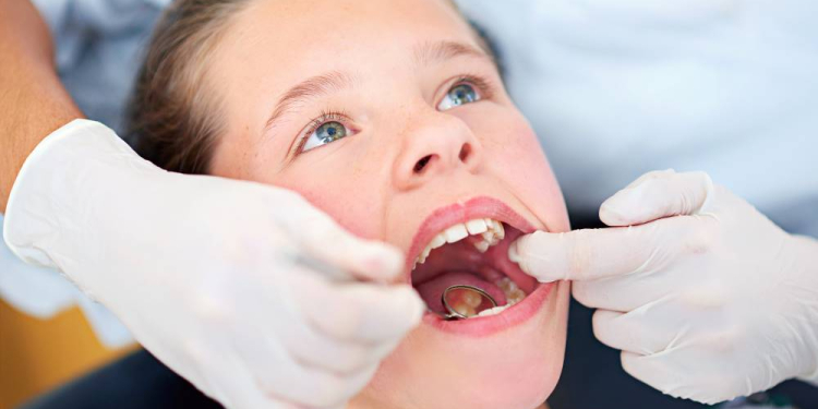 Jeder dritte Erstklässler hat bereits Zahnfüllungen