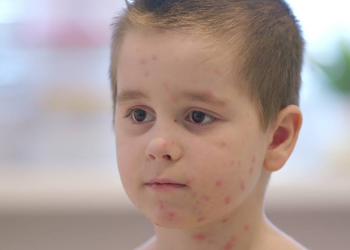 Windpocken-Fälle im Herzogtum Lauenburg rückläufig