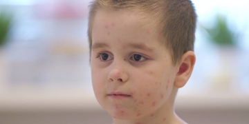 Windpocken-Fälle im Herzogtum Lauenburg rückläufig